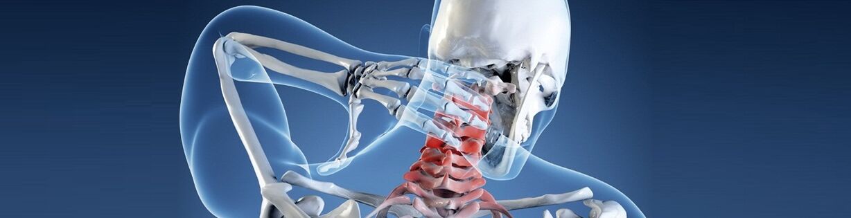 İnsan servikal omurgasının osteokondrozu