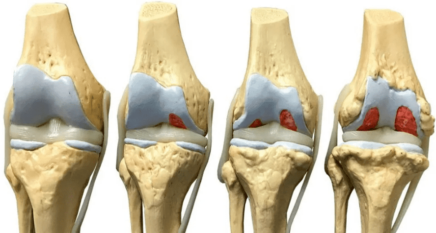 Osteoartrit gelişiminin çeşitli aşamalarında diz ekleminde hasar
