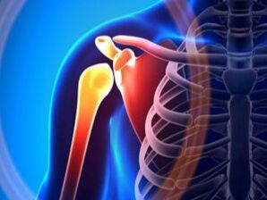 Kas-iskelet sisteminin kronik bir hastalığı olan osteoartrit nedeniyle omuz ekleminin iltihaplanması