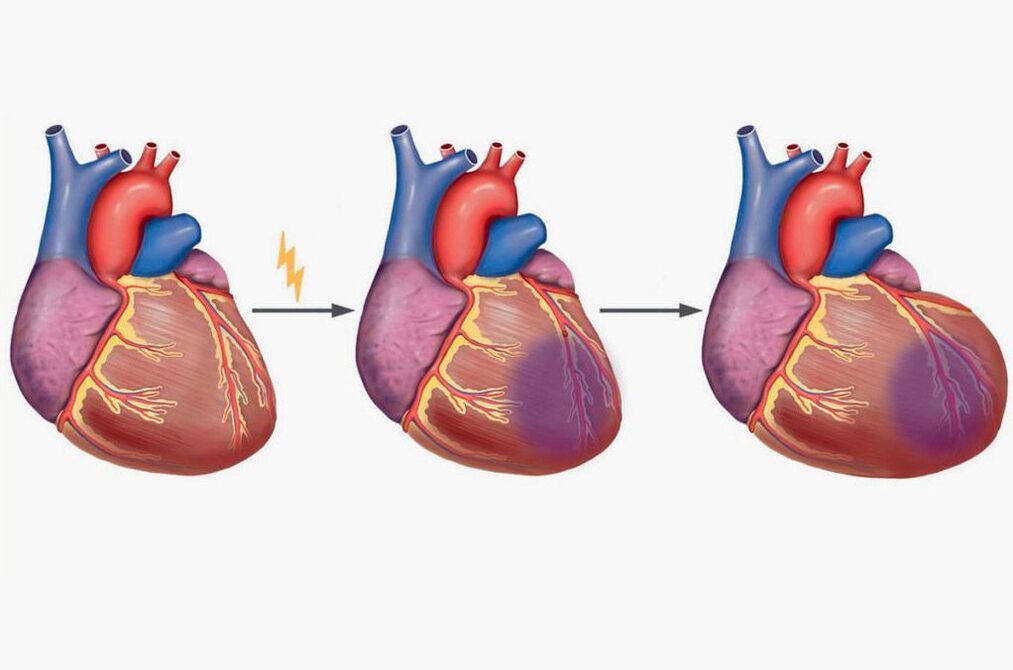 Kalp krizi kürek kemiklerinde ağrıya neden olur