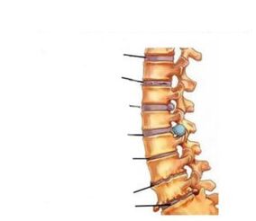 Osteokondroz semptomları
