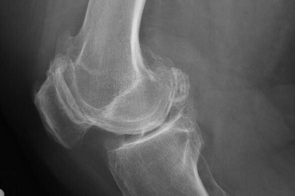 Diz osteoartrit teşhisi için yöntemler
