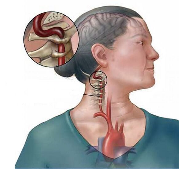 Servikal osteokondrozlu Vertebral arter sendromu